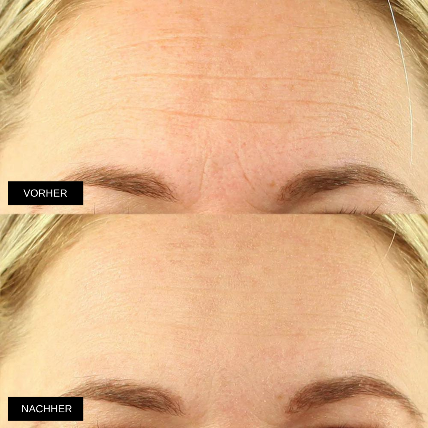 Superlift - 5 coussinets en silicone réutilisables pour lisser et prévenir les rides du visage