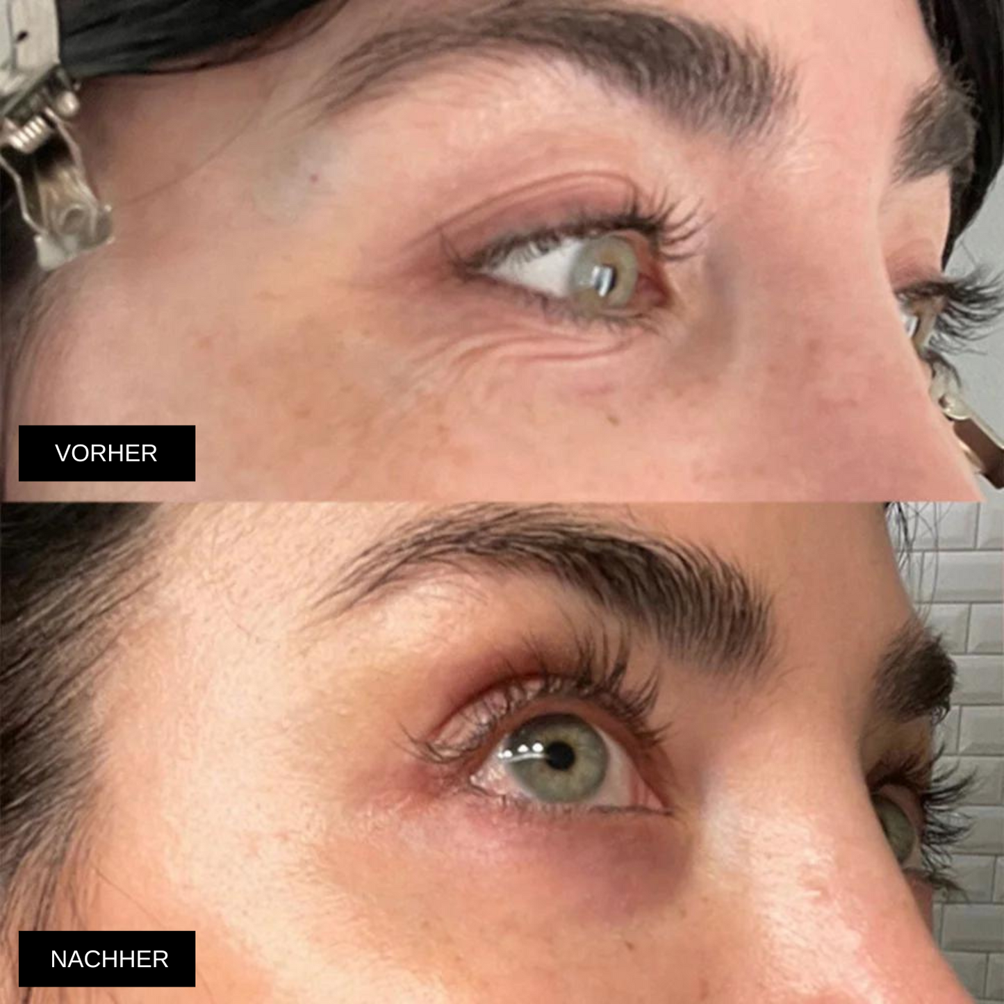Superlift - 5 coussinets en silicone réutilisables pour lisser et prévenir les rides du visage